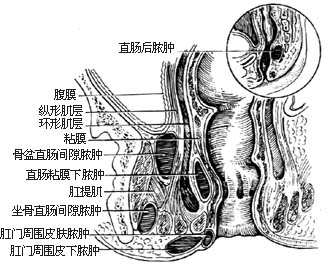 直肠肛管周围脓肿切开引流术