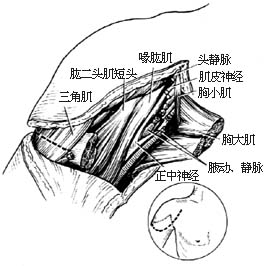 肩关节离断术