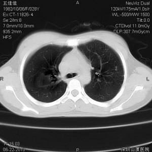 再论微创靶向综合疗法快速治愈耐药性肺结核