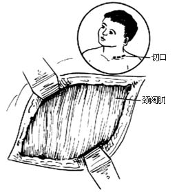 胸锁乳突肌切断术