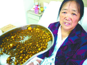 婆婆长期食用腌腊食品胆中取出2050颗结石