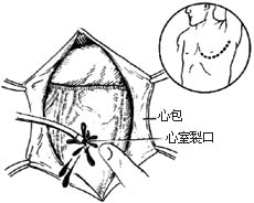 心脏穿透伤缝合术