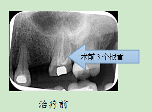 空军总医院：挑战治疗5个根管患牙成功