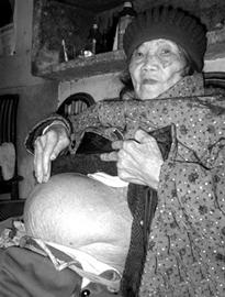 九旬老太身怀死胎58年肚大如篮球