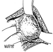 输尿管阴道瘘修补术