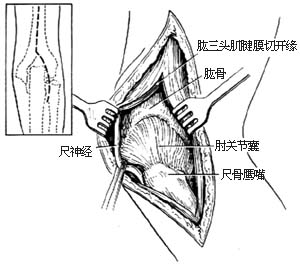 肘关节切除术