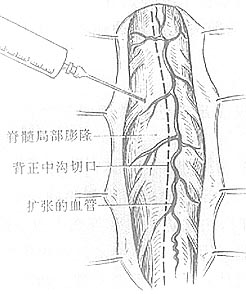 脊髓内肿瘤切除术