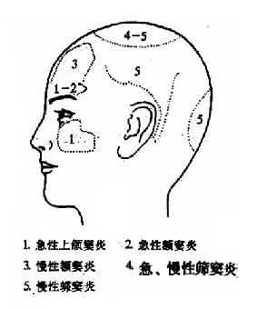 急性化脓性鼻窦炎