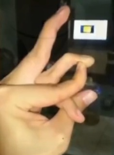 手指拗出又拗入易变畸形