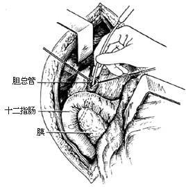 十二指肠乳头括约肌成形术（经十二指肠）