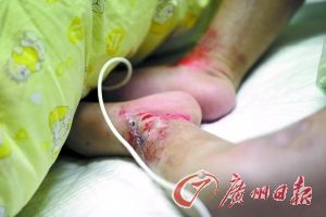 男童脑出血病危 继母涉嫌虐待遭批捕