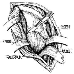 髋关节结核病灶清除术