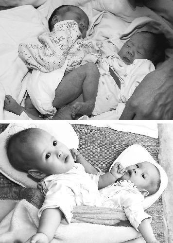 福建：两对连体女婴同时住院