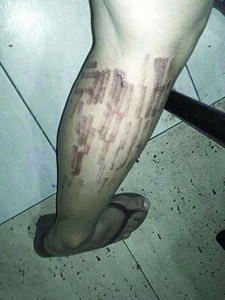 女子进行激光脱毛术留烫疤 美腿惨遭“毁容”