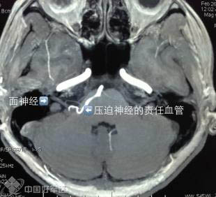眼皮跳跳要注意！未必是好事要来到