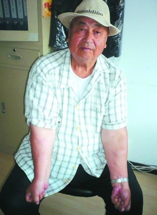 250斤重老汉挥臂展示脂肪瘤 吓跑三名小偷