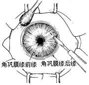 小梁切除术