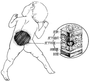 新生儿皮下坏疽切开引流术