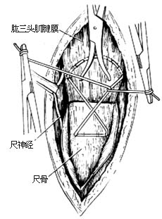 尺骨鹰嘴骨折切开复位内固定术