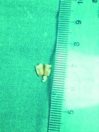 15个月男童吃糖 花生碎钻进气管
