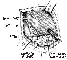 股疝修复术