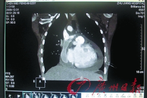 广州日报：“半心人”成功修心