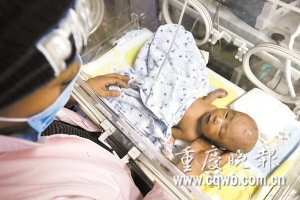 双胞胎出生后遭真菌感染只能二选一