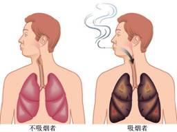 军医解读：吸烟熏黑的肺能灌洗干净吗？