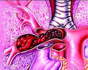 警惕旅途杀手：下肢深静脉血栓及肺栓塞