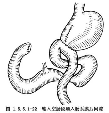 输入空肠段梗阻:billroth Ⅱ式胃部分切除术后发生输入段空肠梗阻的