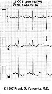 右房扩大 Right Atrial Enlargement
