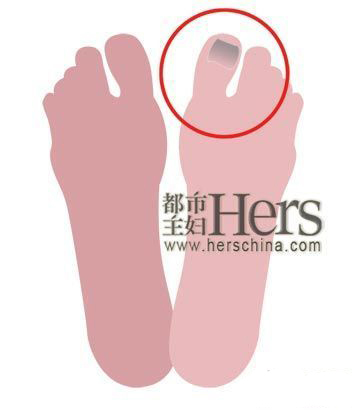 第九大问题：趾甲变了颜色