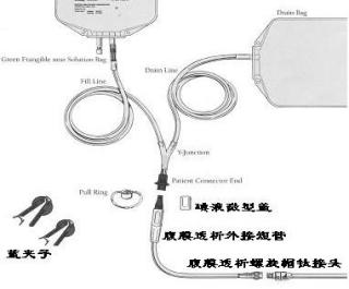 男子自制血透机透析13年 专家支招：腹膜透析可作为首选