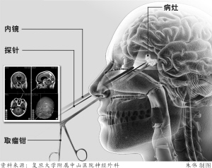 鼻孔“入路”切除脑膜瘤