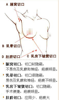 实拍国外隆胸手术全程