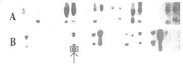 CD28与B7.1共刺激PBLs受肝癌细胞诱导后的TCR Vβ基因表达