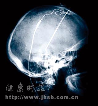 1毫米“起搏器”唤醒植物人