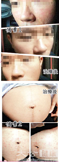 中医师：湿疹之苦根治的关键是疏风养血 标本兼治