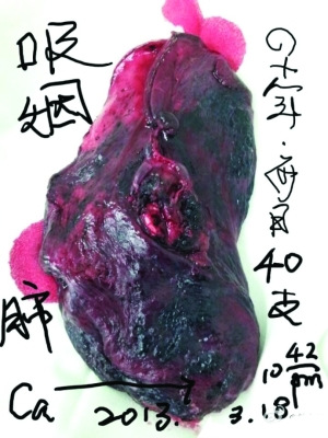 八成肺病患者是“黑肺” 永远都不会褪色