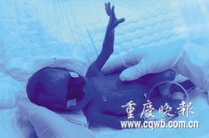 重庆诞生最袖珍的婴儿：体重一斤二两