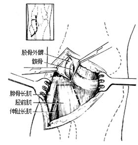胫骨平台骨折切开复位内固定术