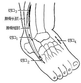 腓骨长肌腱转移术