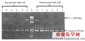 甲基强的松龙对哮喘患儿PBMC分泌TH源性细胞因子的影响作用研究