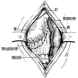 脾切除术