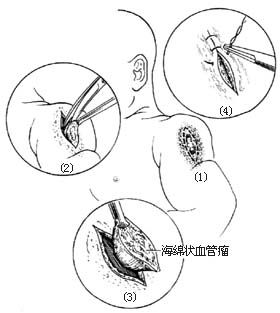 毛细血管瘤和海绵状血管瘤切除术