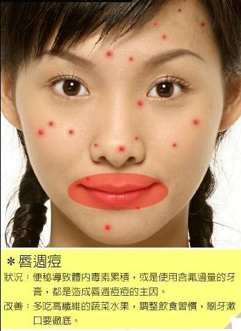 通过脸上痘痘位置看你的健康状况