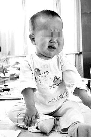 1岁男童患怪病后半侧躯体肥胖