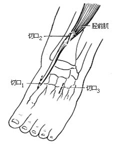 胫前肌腱转移术