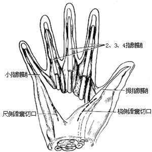 化脓性腱鞘炎切开引流术