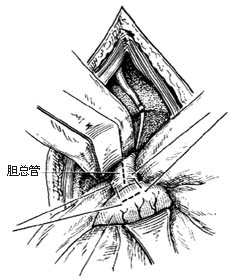 胆总管十二指肠侧侧吻合术